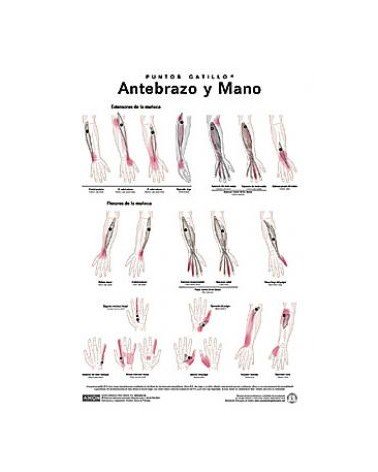 Lamina de pared Puntos Gatillo Antebrazo Y Mano