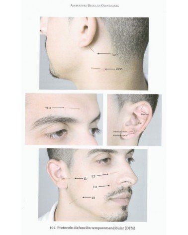 Acupuntura básica en odontología, por Dr. Vicente Vicente Calderón / Ibán Jesús Muñoz Gómez. Editorial Edaf