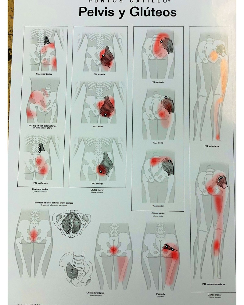 Lamina de pared Puntos Gatillo Pelvis Y Gluteos