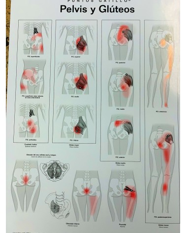 Lamina de pared Puntos Gatillo Pelvis Y Gluteos